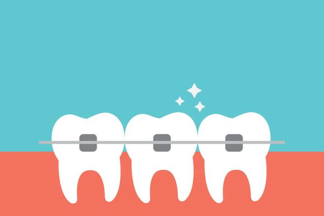 “静”享健康丨矫正牙齿不易佩戴保持器怎么选？(图1)