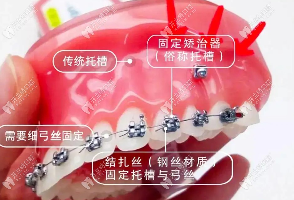 2024医院牙齿矫正收费价目表含钢牙套隐形牙套等价格表(图2)