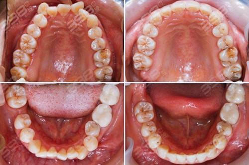 2024牙齿矫正价目表更新至2025各种牙套的种类和价格都有(图1)