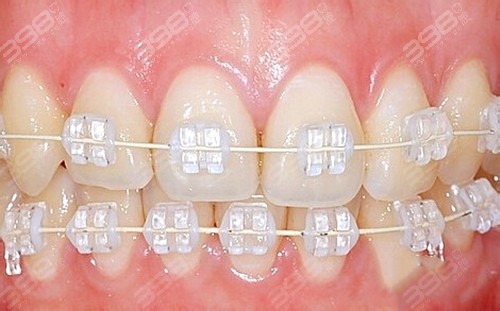 2024牙齿矫正价目表更新至2025各种牙套的种类和价格都有(图3)