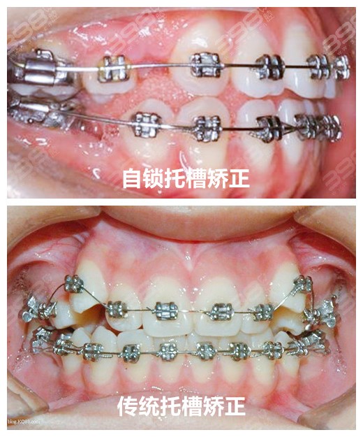 2024牙齿矫正价目表更新至2025各种牙套的种类和价格都有(图2)