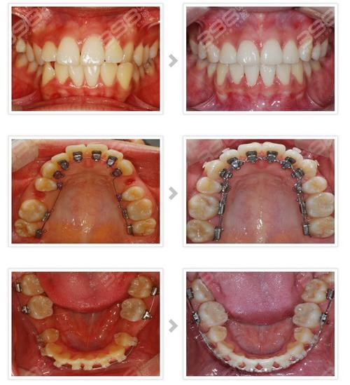 2024牙齿矫正价目表更新至2025各种牙套的种类和价格都有(图6)