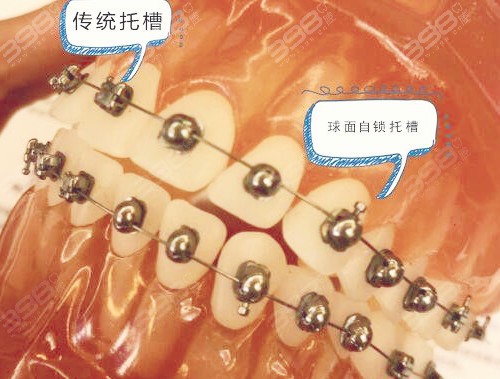 2024牙齿矫正价目表更新至2025各种牙套的种类和价格都有(图4)