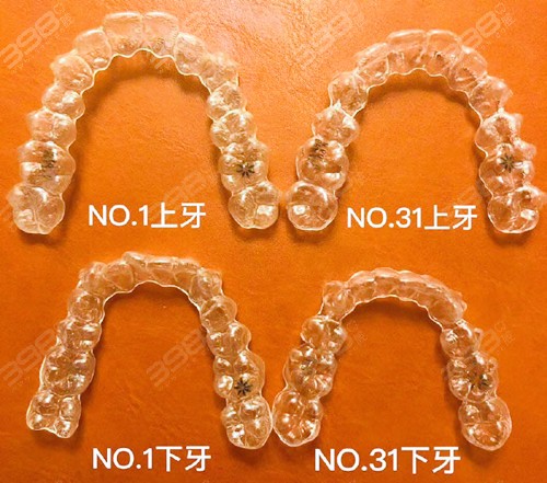 2024牙齿矫正价目表更新至2025各种牙套的种类和价格都有(图5)
