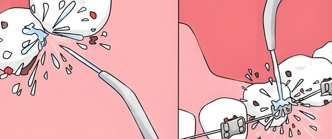 水牙线适用人群分析(图1)